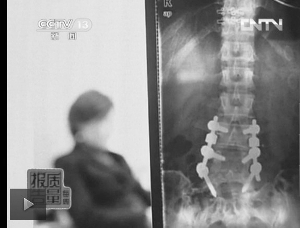 圖1：教練按壓導(dǎo)致學(xué)員腰椎間盤突出。（央視截屏）