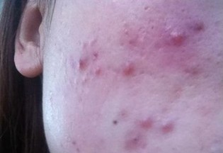 無限極排毒養(yǎng)顏產(chǎn)品用后長膿包 店員稱正常